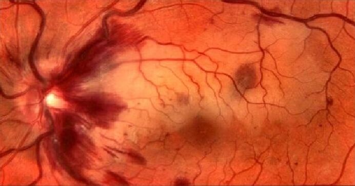 retinalne krvne žile i vraćanje vida